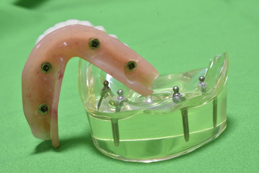 alt çene 4 implant üzeri protez çıt çıtlı